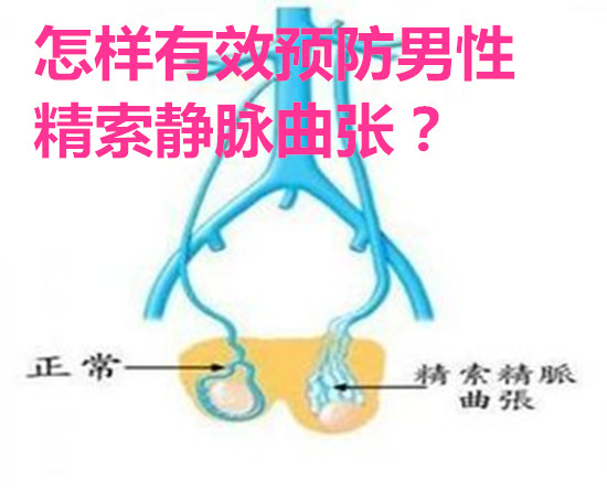 怎样有效预防男性精索静脉曲张?