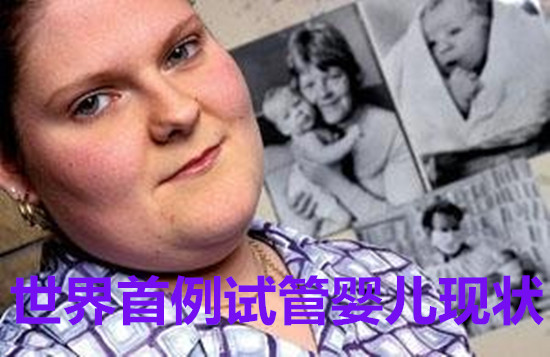 世界首例试管婴儿现状